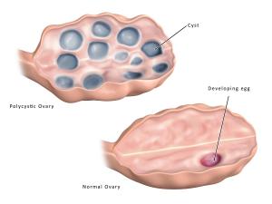 다낭성난소증후군과 자궁내막증 관계,난소물혹증상이 자궁내막암 원인 다낭성난소증후군과 자궁내막증 관계,난소물혹증상이 자궁내막암 원인